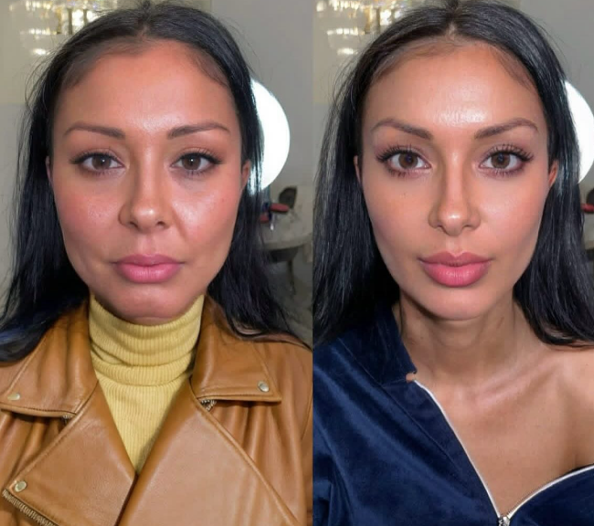 6 weeks after procedure — filler plus Botox